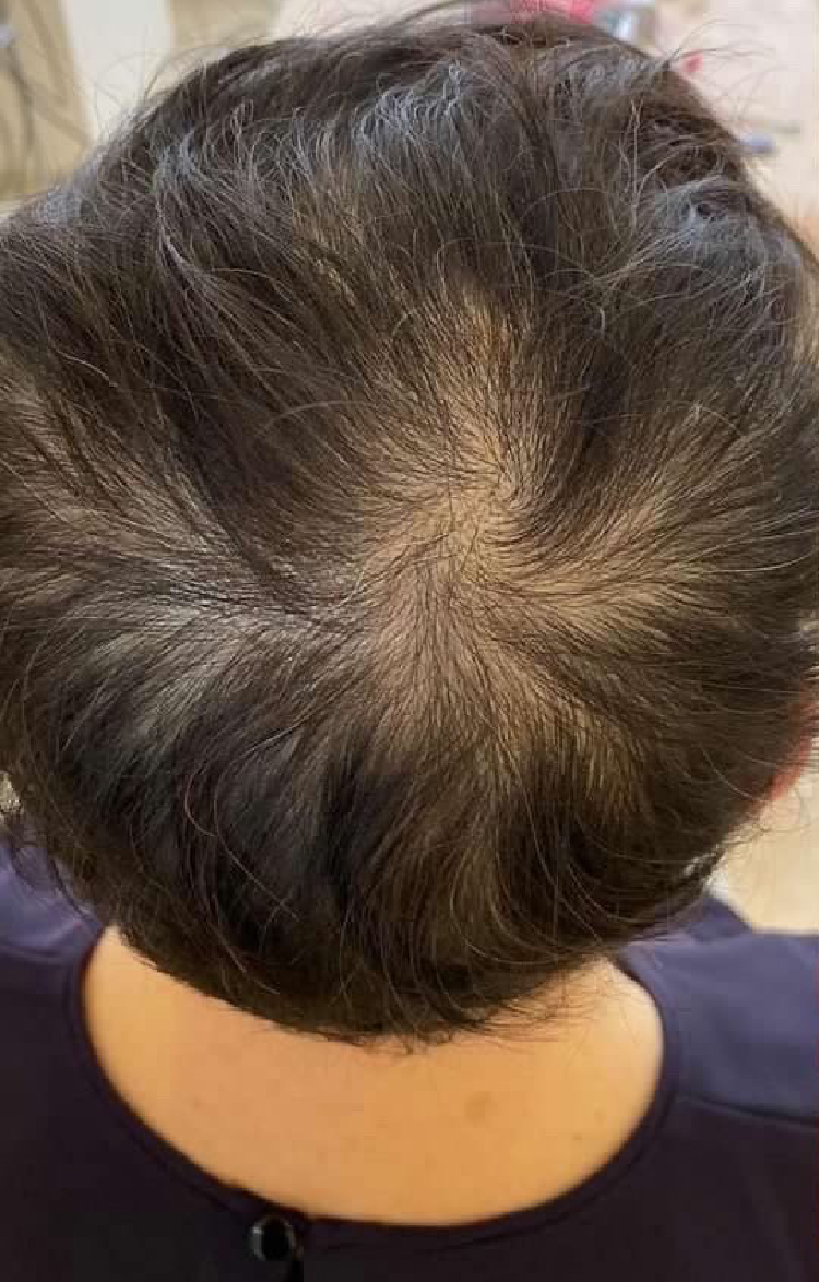40代男性 頭頂部の薄毛 Before